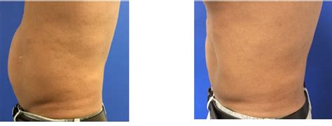 velashape 3 before and after|velashape before and after thighs.